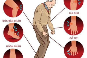  GOUT - CĂN BỆNH THỜI ĐẠI 