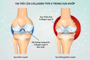 COLLAGEN Type 2 VÀ VAI TRÒ VỚI XƯƠNG KHỚP
