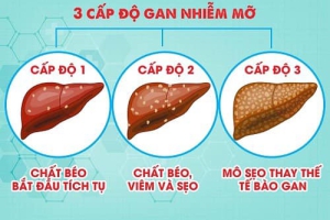 GAN NHIỄM MỠ - NGUYÊN NHÂN VÀ CÁCH PHÒNG NGỪA 