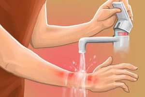 CÁCH CHĂM SÓC BỎNG DA TẠI NHÀ