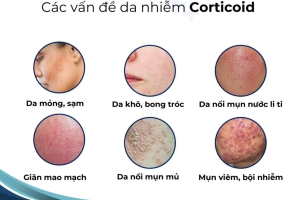 CẨN TRỌNG KHI SỬ DỤNG THUỐC BÔI DA CÓ CHỨA CORTICOID 