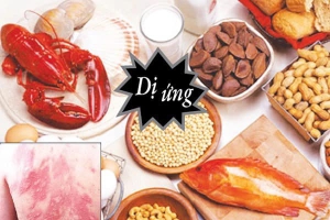  Phòng ngừa dị ứng thức ăn 