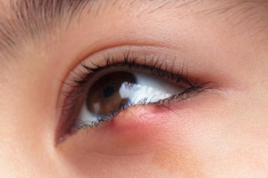 LẸO MẮT LÀ GÌ???