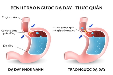 TRÀO NGƯỢC DẠ DÀY CÓ LÀM TĂNG HUYẾT ÁP KHÔNG? 