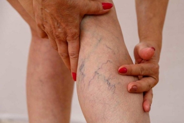  Những Cách Phòng Tránh Giãn Tĩnh Mạch Hiệu Quả Bạn Cần Biết