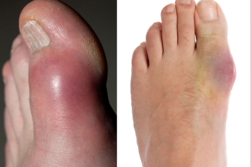 GOUT: CƠN ĐAU KHÔNG BÁO TRƯỚC