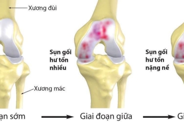 NGUYÊN NHÂN GÂY MẤT SỤN KHỚP