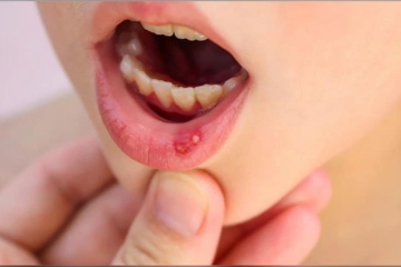 NHIỆT MIỆNG LÀ GÌ ??