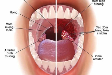  HÔI MIỆNG - NGUYÊN NHÂN VÀ BIỆN PHÁP PHÒNG NGỪA