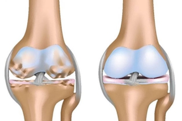 KHÔ KHỚP DO ĐÂU? CÁCH PHÒNG TRÁNH KHÔ KHỚP?