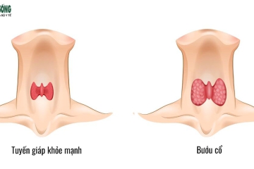 BƯỚU CỔ LÀ GÌ?