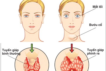 BƯỚU CỔ: TRIỆU CHỨNG – NGUYÊN NHÂN – ĐIỀU TRỊ