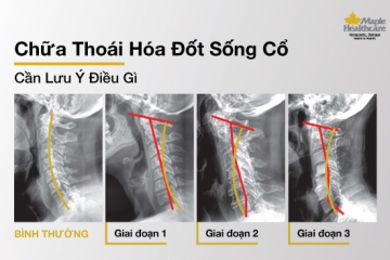 THOÁI HÓA ĐỐT SỐNG CỔ: KHÔNG CHỈ NGƯỜI LỚN TUỔI MỚI GẶP