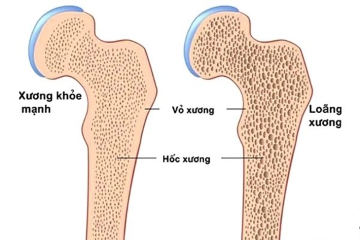 CÁC YẾU TỐ,  NGUY CƠ DẪN TỚI BỆNH LOÃNG XƯƠNG