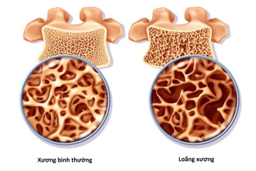 LOÃNG XƯƠNG: KHÔNG ĐAU NHƯNG RỦI RO LỚN